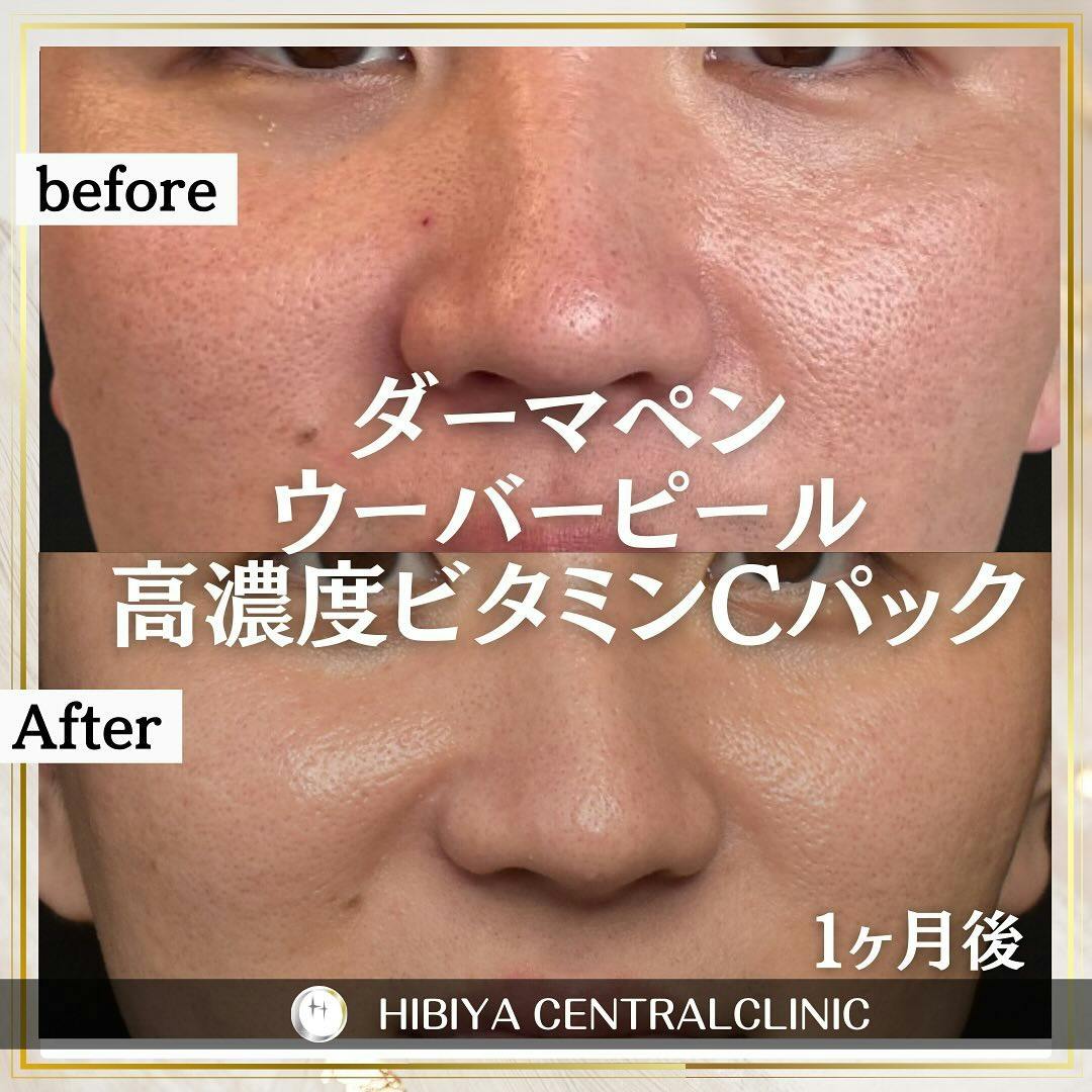 【男性・肌】ダーマペン・ウーバーピール_before_aftar