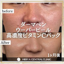 【男性・肌】ダーマペン・ウーバーピール_before_aftar