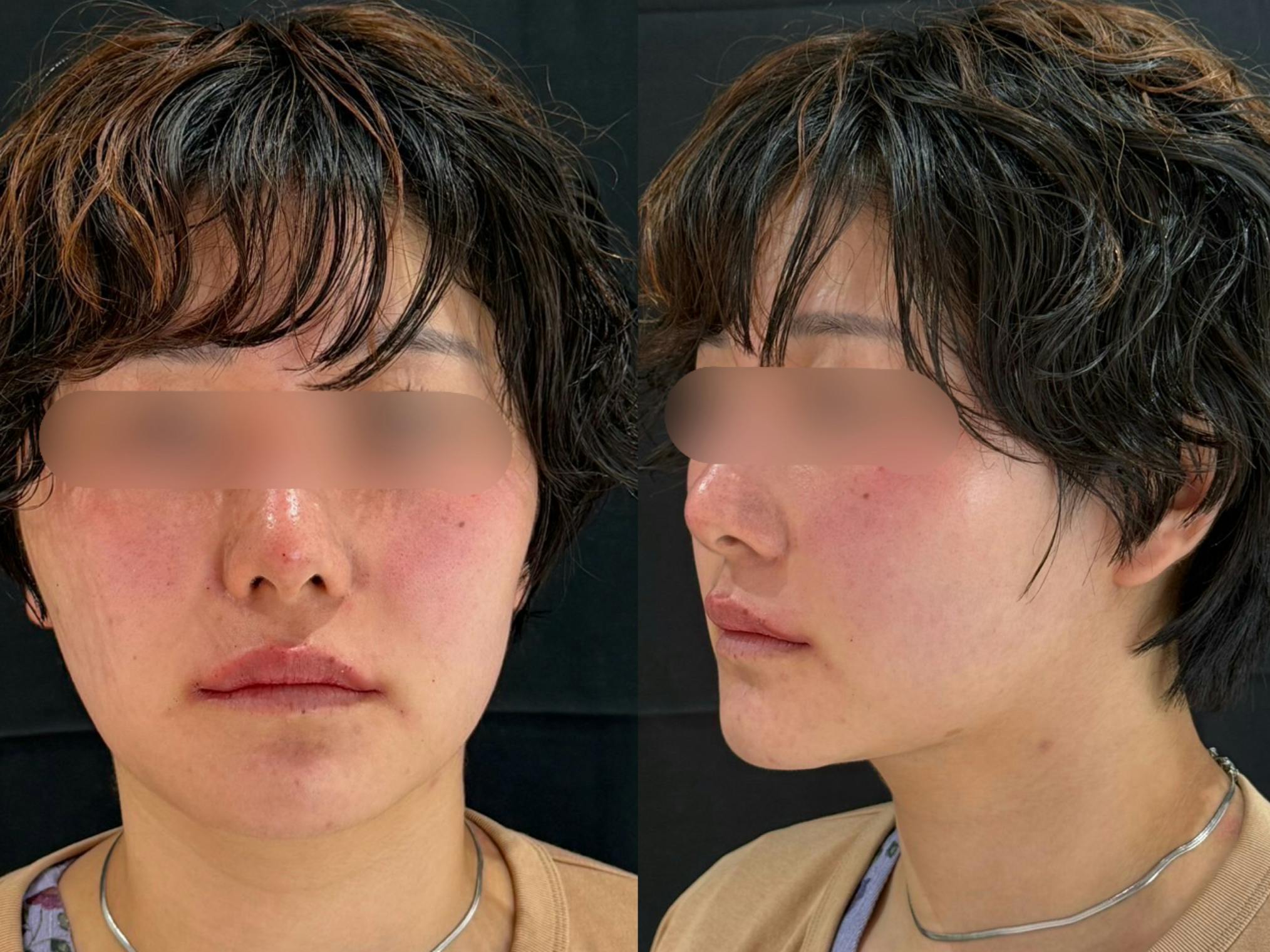 ヒアルロン酸_after