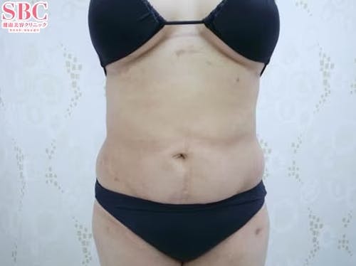 【女性・腹部】根こそぎVASER脂肪吸引、ライポマティック脂肪吸引、Aquicell（アキーセル）脂肪吸引_aftar