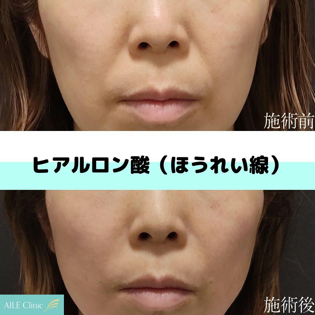 【女性・ほうれい線】ヒアルロン酸注入_before_aftar