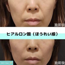 【女性・ほうれい線】ヒアルロン酸注入_before_aftar