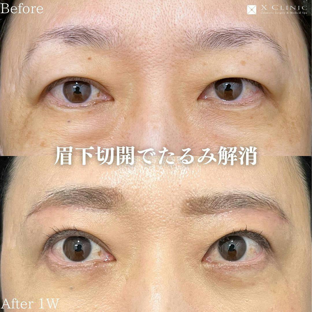 【40代女性・目元】眉下切開_before_aftar