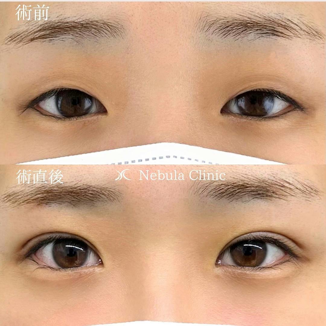 【女性・目元】二重埋没法_before_aftar