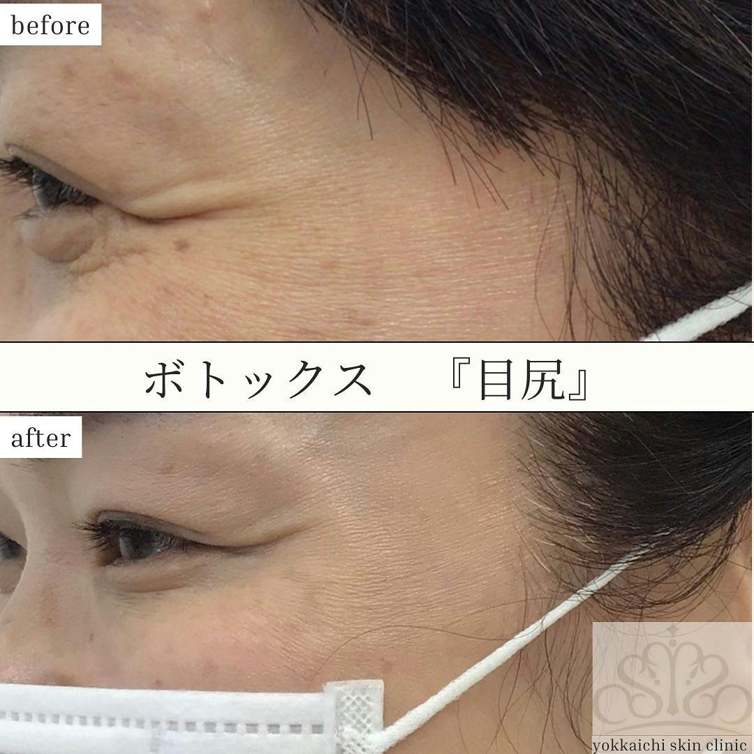 顎のボトックス注射・目尻ボトックス注射・眉間ボトックス注射・おでこ(額)ボトックス注射・バニーライン・鼻根ボトックス注射・ボトックス注射・アラガン製 ボトックスの症例写真・ビフォーアフター画像No.3130 | 四日市ヒフ科クリニック, image size:1080x1080