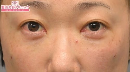 【50代女性・目元】目の下の切らないクマ・たるみ（ふくらみ）取り ナチュラル脂肪注射コンデンスリッチ ナチュラル脂肪注射ナノリッチ_after