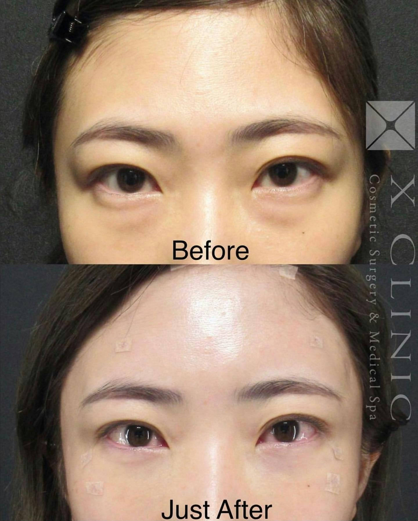 【女性・目元】クマ取りフルコース 額こめかみ脂肪注入_before_aftar