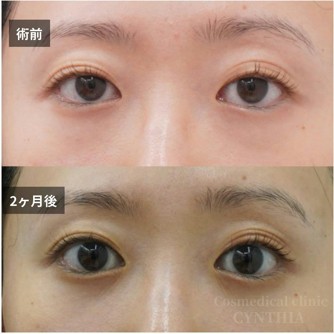 【30代女性・目元】経結膜脱脂術・眼窩脂肪注入_before_aftar