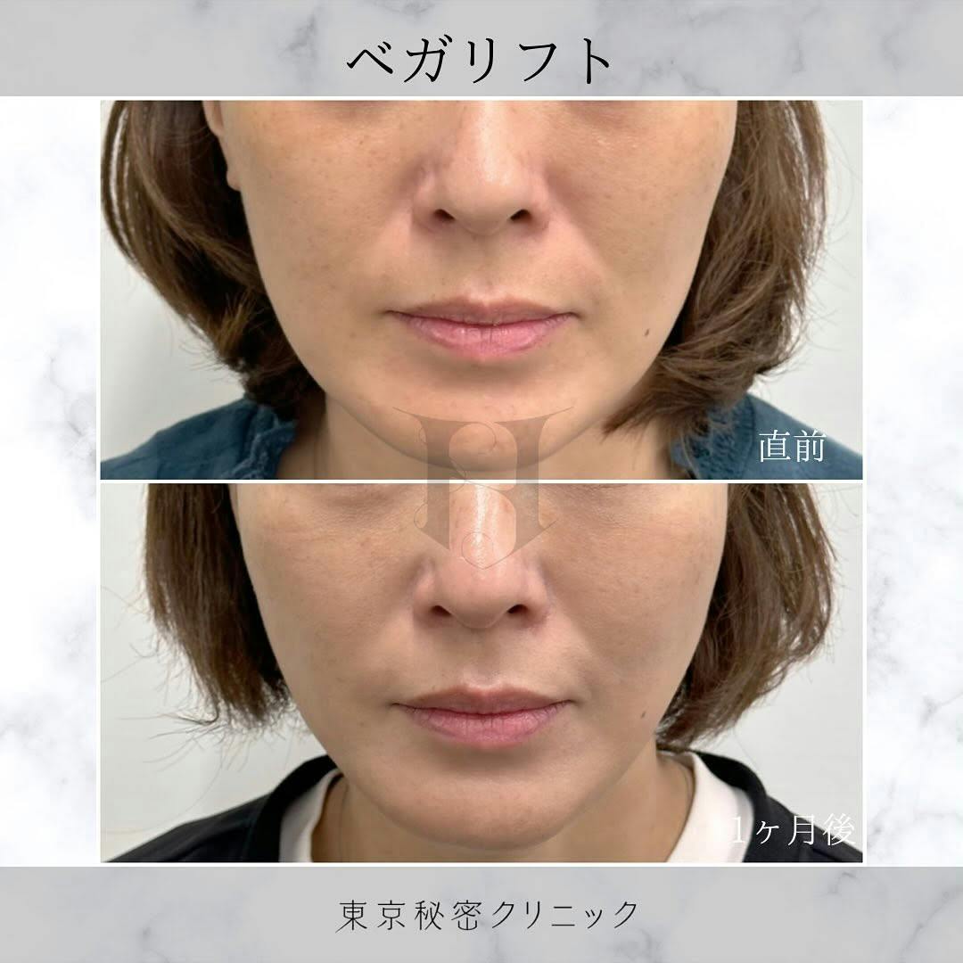 【女性・たるみ】糸リフト（ベガリフト）_before_aftar