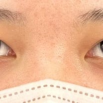 【10代女性・目元】Teen二重(R)、自然癒着法_before