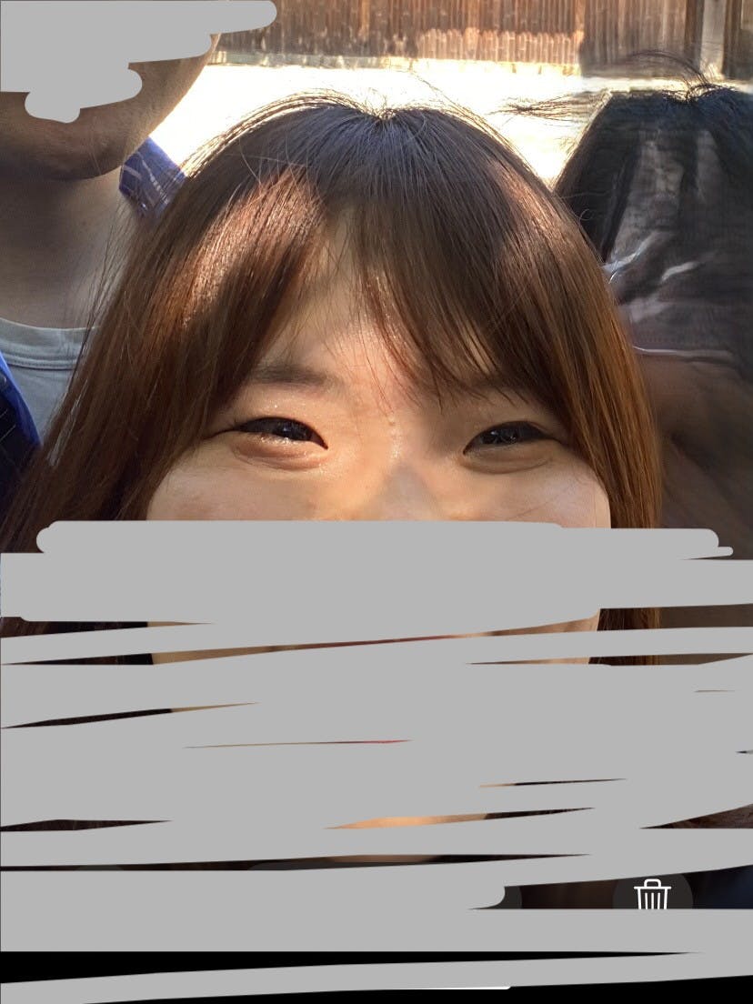 湘南美容クリニック 橋本院で目の下のクマ・たるみ取り（裏ハムラ法）を受けた山藤さんの写真