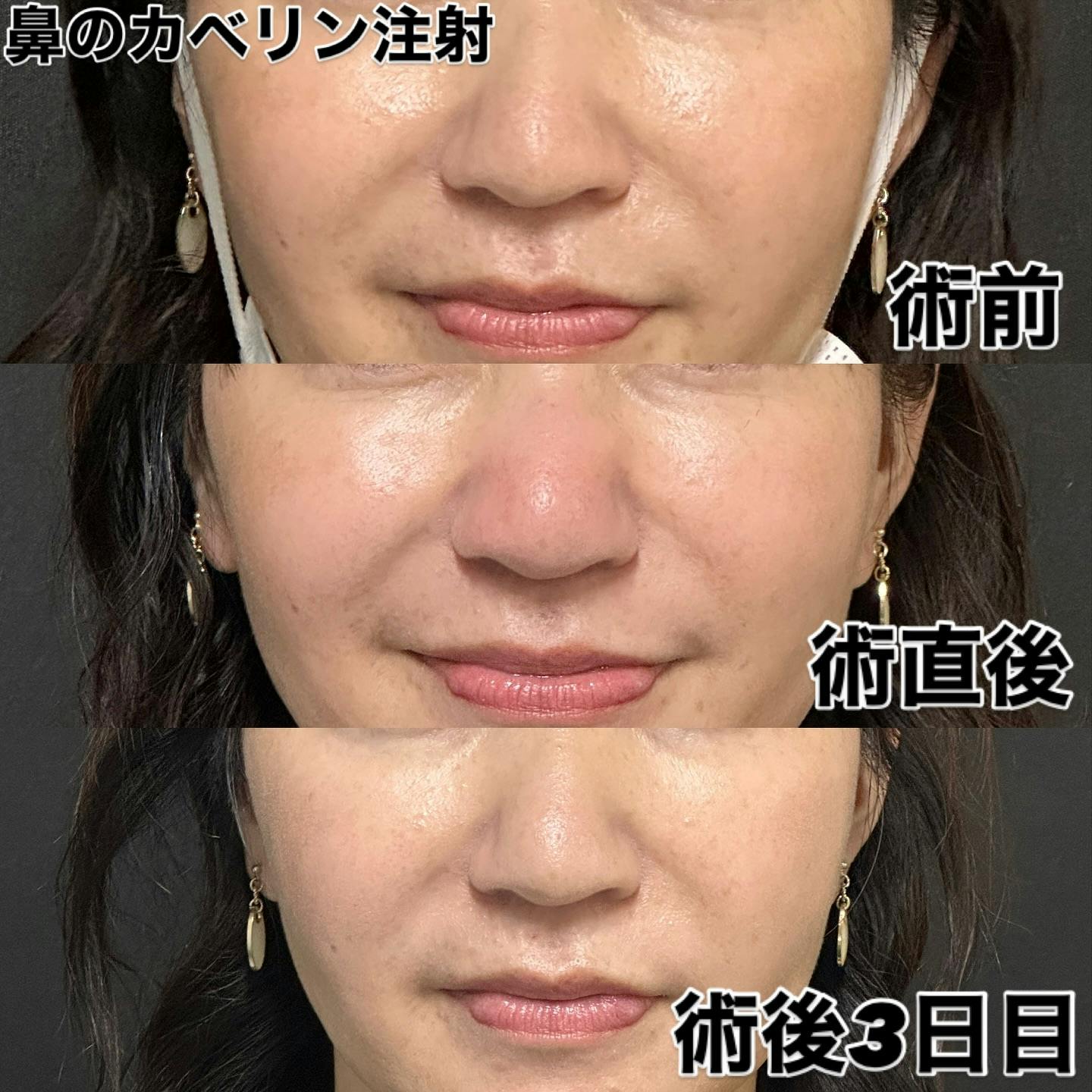 【女性・鼻】鼻のカベリン注射_before_aftar
