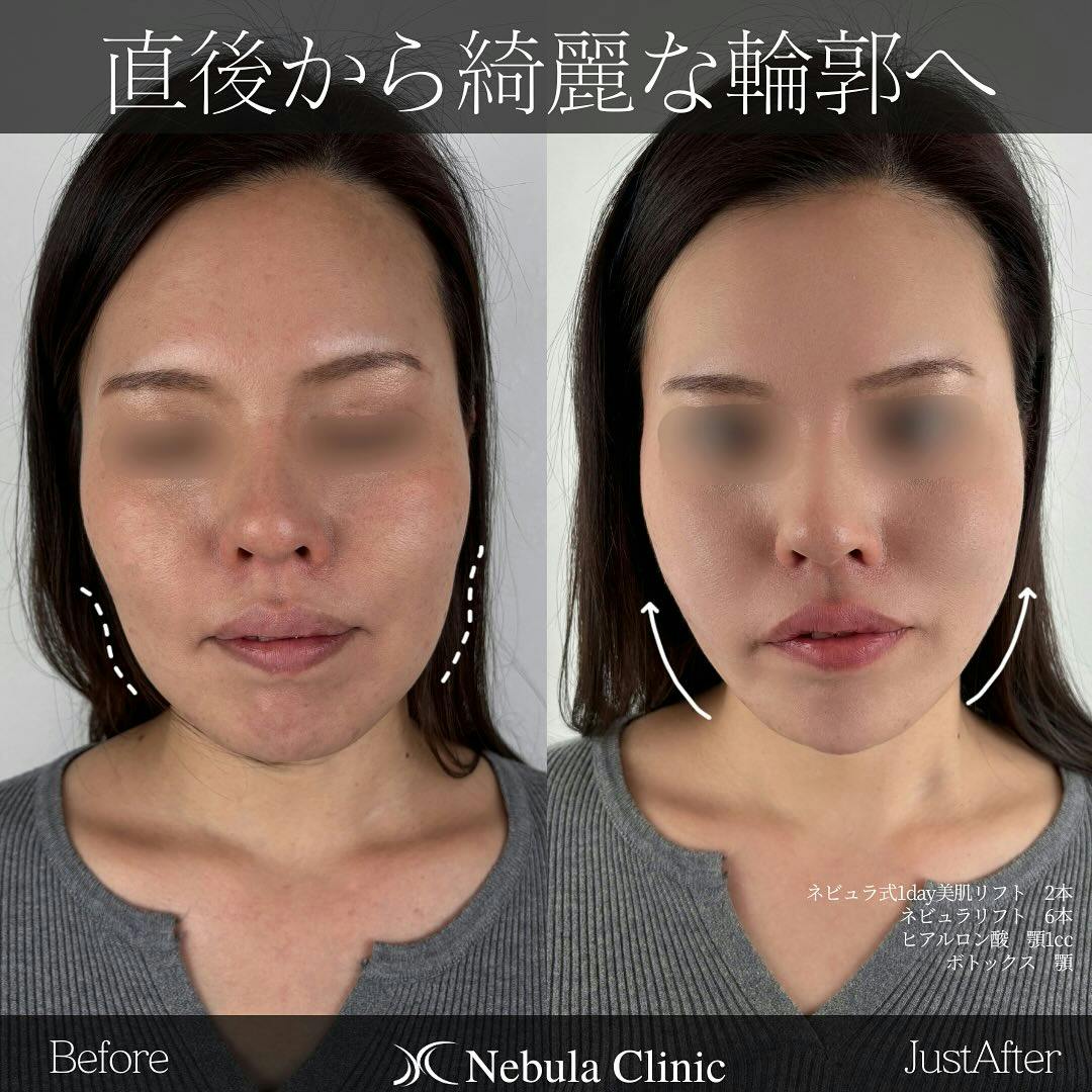 【女性・顔・顎】糸リフト、ヒアルロン酸注入(顎)、ボトックス(顎)_before_aftar