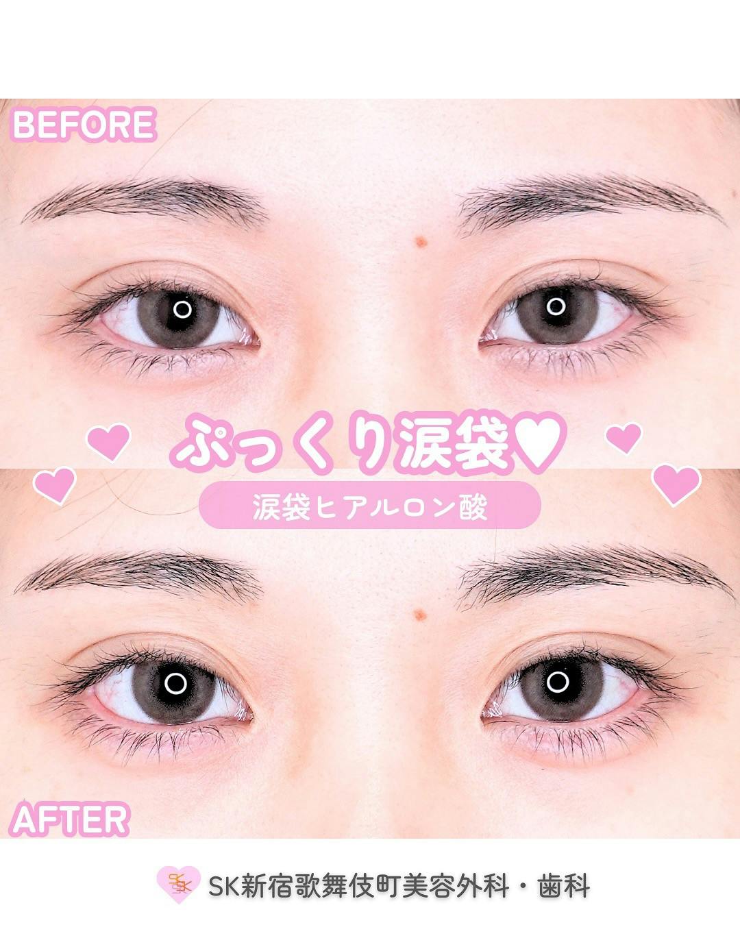 【女性・目元】涙袋ヒアルロン酸_before_aftar