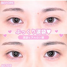 【女性・目元】涙袋ヒアルロン酸_before_aftar