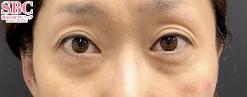 【40代女性・目元】ナチュラル脂肪注射コンデンスリッチ、ナチュラル脂肪注射ナノリッチ、目の下の切らないクマ・たるみ（ふくらみ）取り_before