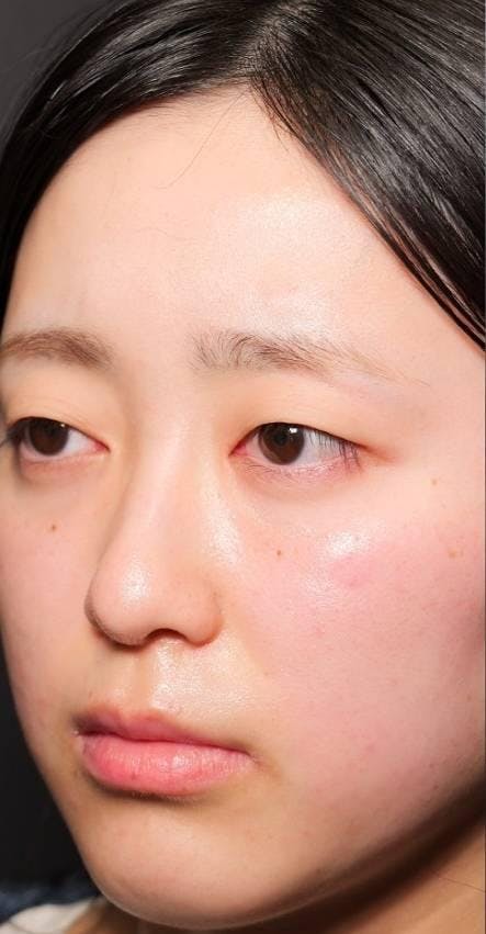 ルラ美容クリニック 渋谷本院で二重埋没：1dayルラライン二重術両目4点留めを受けたMAIさんの写真