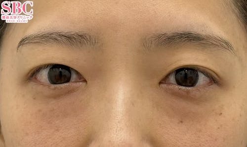 【30代女性・目元】目の下の切らないクマ・たるみ（ふくらみ）取り、ナチュラル脂肪注射_before