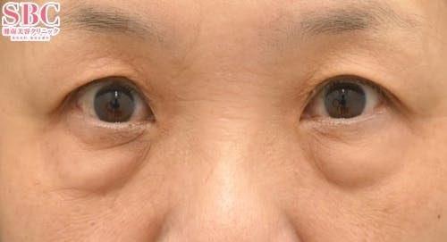 【60代女性・目元】アイバックリムーブ法、ナチュラル脂肪注射コンデンスリッチ、ナチュラル脂肪注射ナノリッチ_before