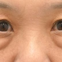 【60代女性・目元】アイバックリムーブ法、ナチュラル脂肪注射コンデンスリッチ、ナチュラル脂肪注射ナノリッチ_before