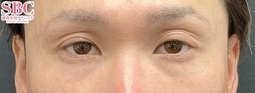 【30代男性・目元】目の下の切らないクマ・たるみ（ふくらみ）取り、ナチュラル脂肪注射コンデンスリッチ、ナチュラル脂肪注射ナノリッチ_before