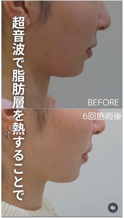 【女性・顎】リニア_before_aftar