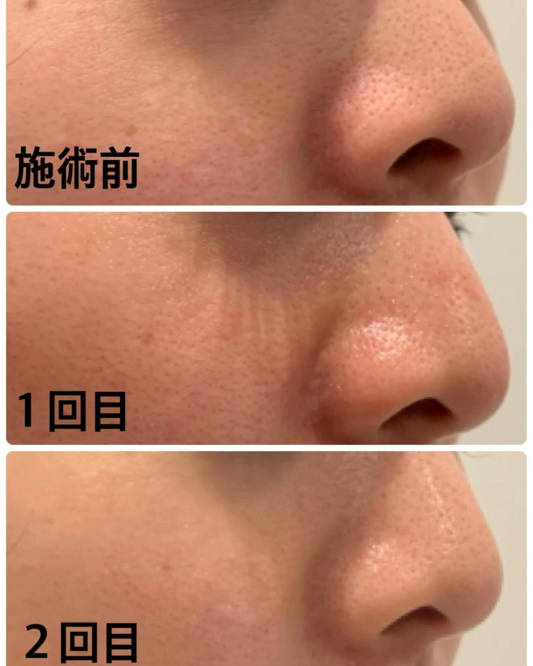 【女性・毛穴】ヴェルベットスキン_before_aftar