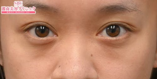 【30代女性・目元】目の下の切らないクマ・たるみ（ふくらみ）取り ナチュラル脂肪注射コンデンスリッチ ナチュラル脂肪注射ナノリッチ_before