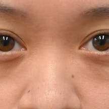 【30代女性・目元】目の下の切らないクマ・たるみ(ふくらみ)取り ナチュラル脂肪注射コンデンスリッチ ナチュラル脂肪注射ナノリッチ_before