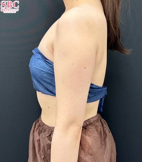 【女性・二の腕】Aquicell(アキーセル)脂肪吸引・根こそぎVASER脂肪吸引_before