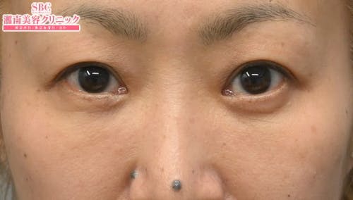 【40代女性・目元】目の下の切らないクマ・たるみ（ふくらみ）取り ナチュラル脂肪注射コンデンスリッチ ナチュラル脂肪注射ナノリッチ_after