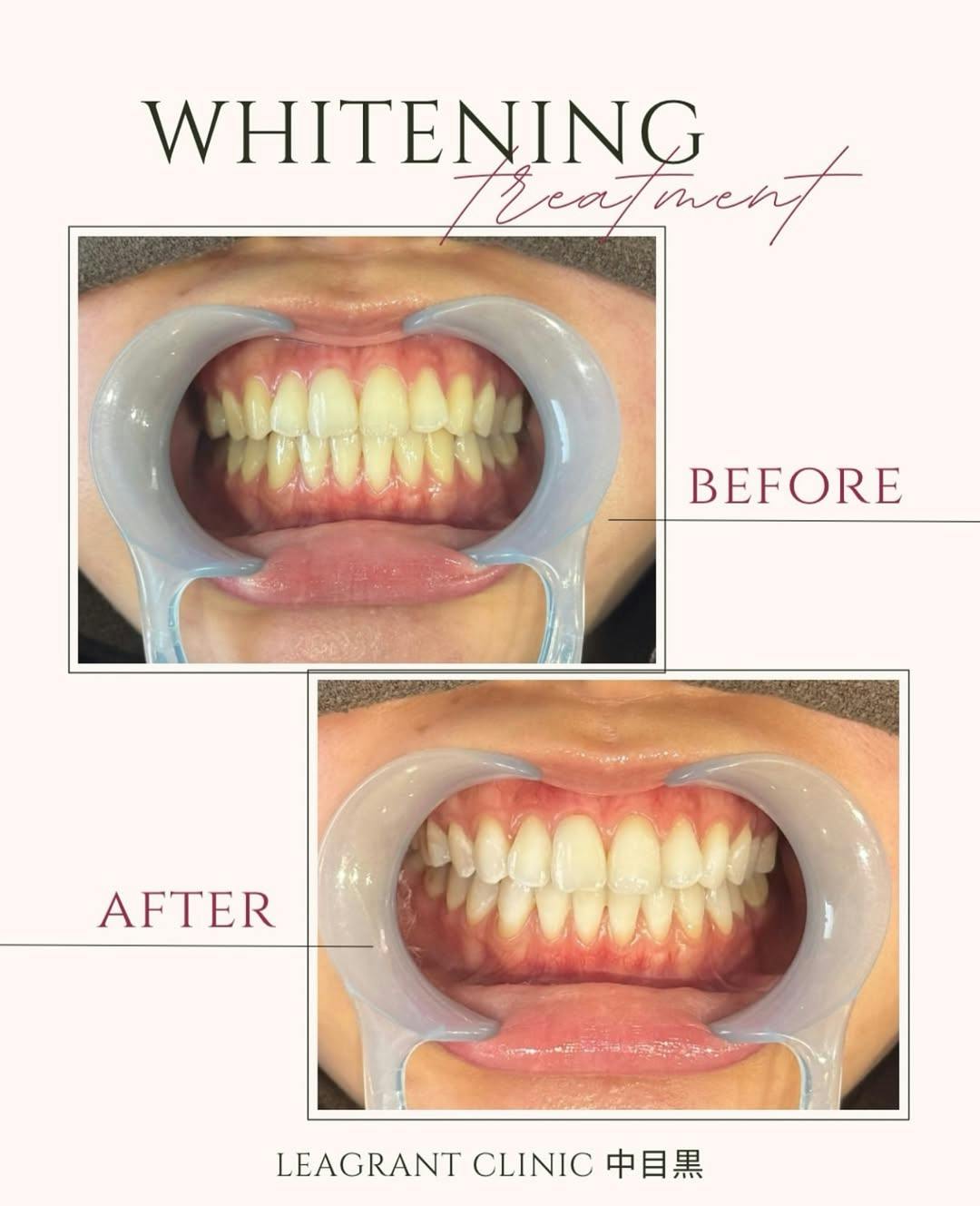 【20代女性・歯】ポリリンホワイトニング_before_aftar