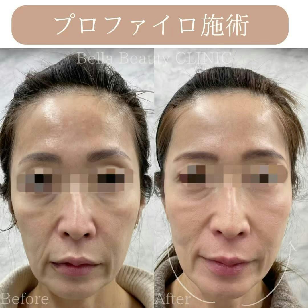 【女性・ハリ】プロファイロ_before_aftar