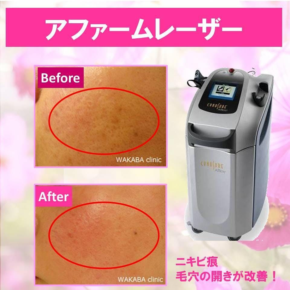 【ハリ】アファームレーザー_before_aftar