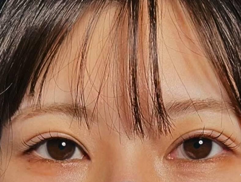 品川美容外科渋谷院（※品川スキンクリニック提携）で二重埋没法：二重術1dayナチュラルプレミアム法（埋没法）を受けたゼブラさんの写真