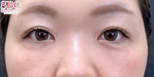 【40代女性・クマ】裏ハムラ法、ナチュラル脂肪注射ナノリッチ_after