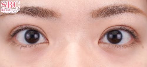 【20代女性・目元】ハイブリッド式二重術_1week