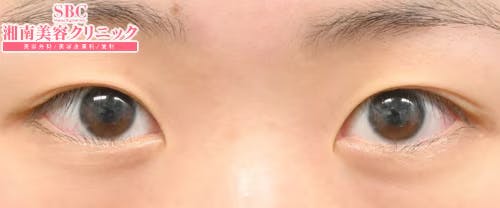 【女性・目元】クイックコスメティーク・トリプルNeo_before