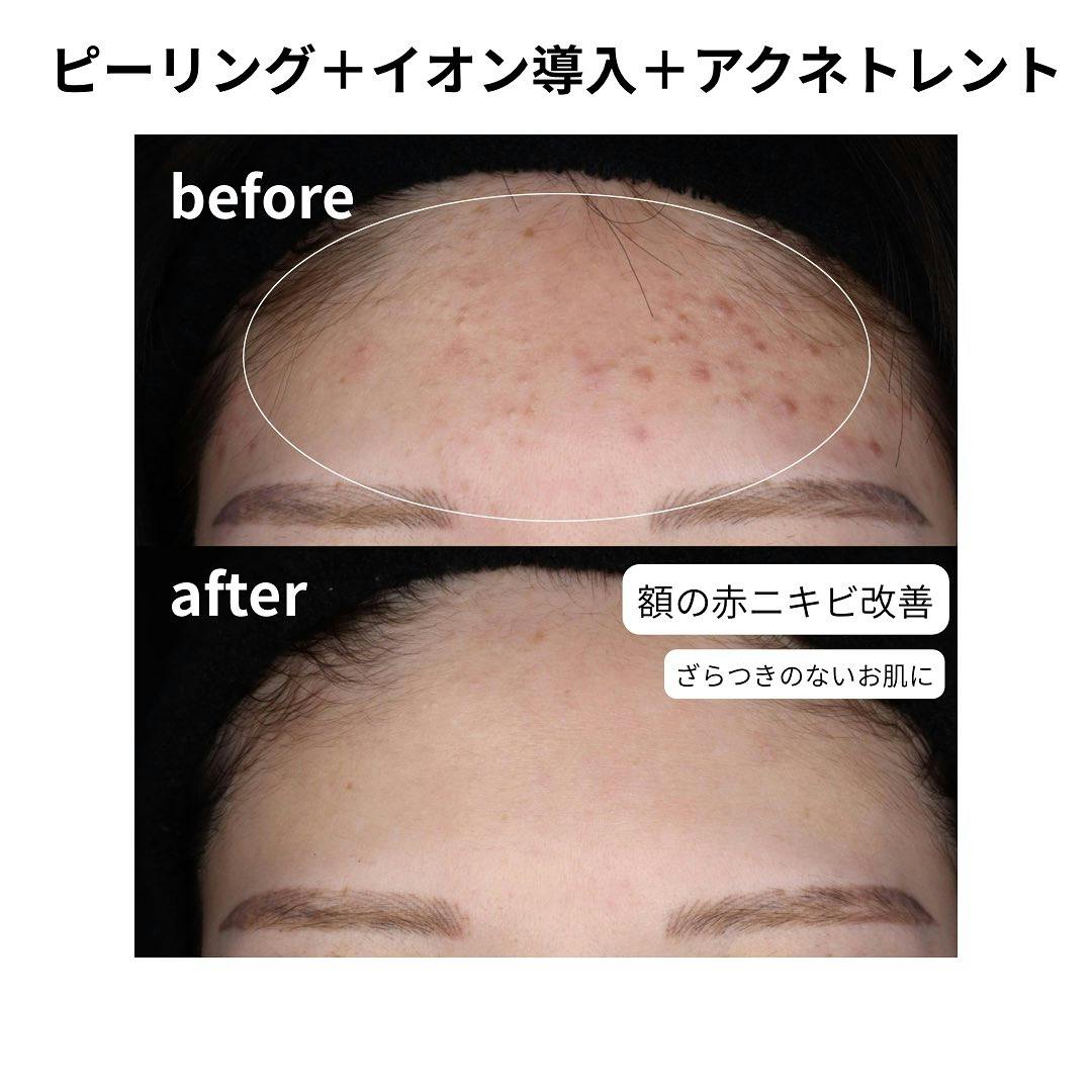 【女性・顔】ピーリング＋イオン＋アクネトレント_before_aftar