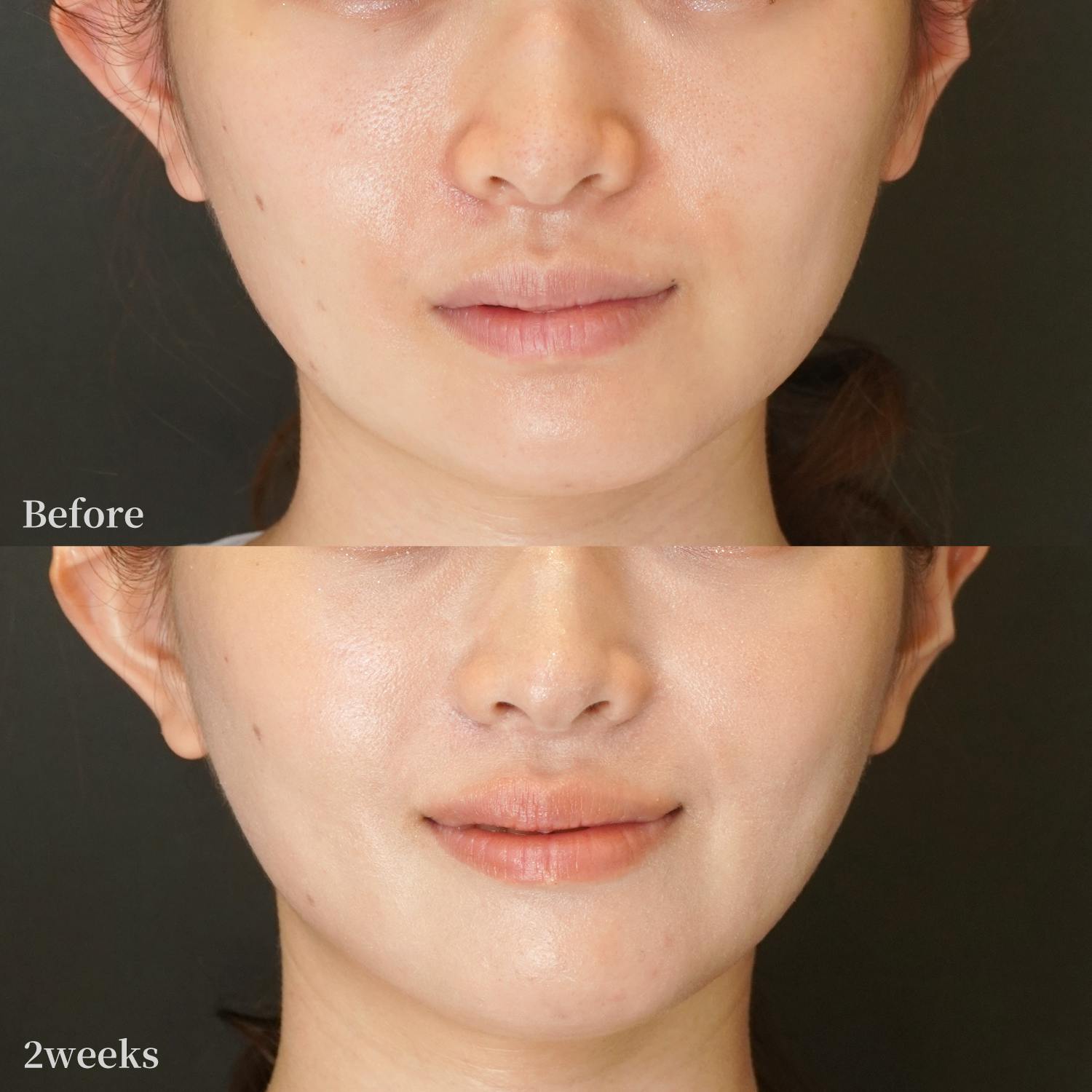 オリジオkiss_before_after