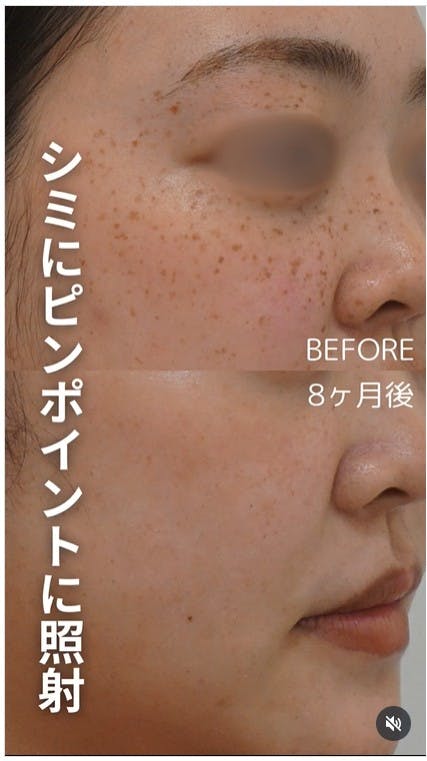【女性・シミ】ピコスポット_before_aftar