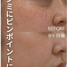 【女性・シミ】ピコスポット_before_aftar