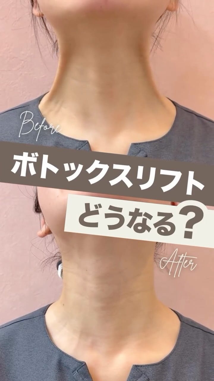 【女性・首元】ボトックスリフト_before_aftar