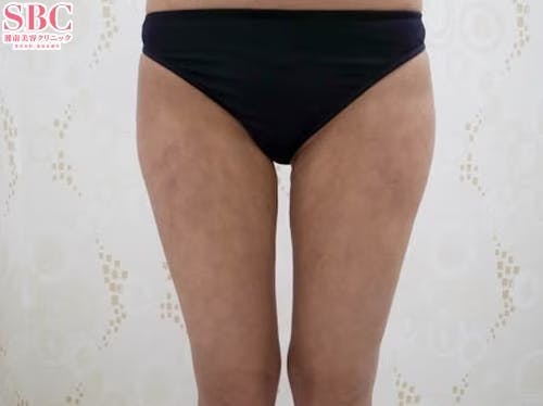 【女性・太もも】根こそぎVASER脂肪吸引、ライポマティック脂肪吸引、Aquicell（アキーセル）脂肪吸引_aftar