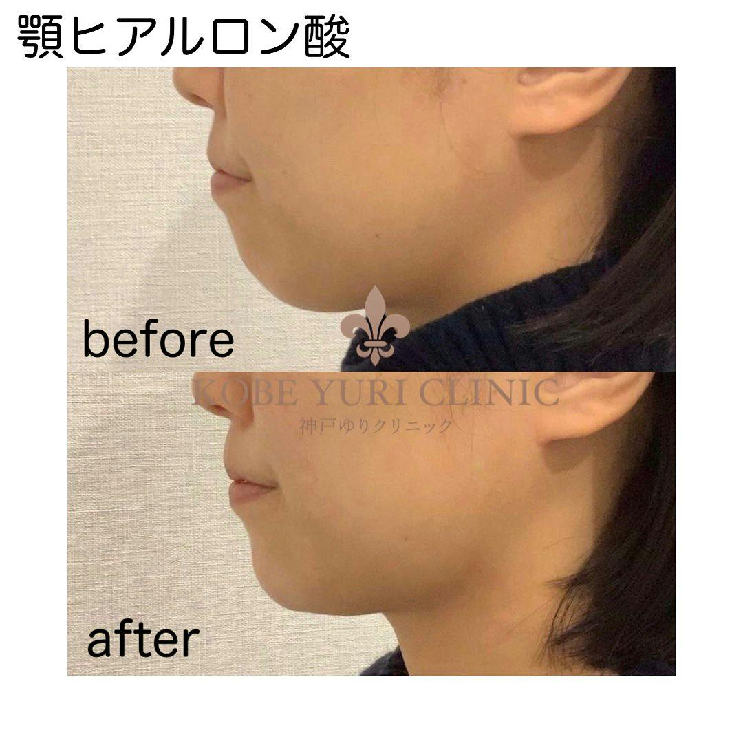 【女性・顎】ヒアルロン酸（顎）_before_aftar