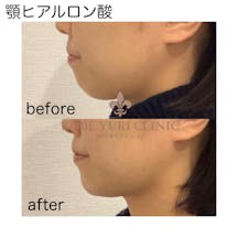 【女性・顎】ヒアルロン酸(顎)_before_aftar
