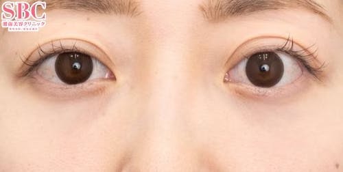 【30代女性・目元】目の下の切らないクマ・たるみ（ふくらみ）取り、ナチュラル脂肪注射コンデンスリッチ、ナチュラル脂肪注射ナノリッチ_after