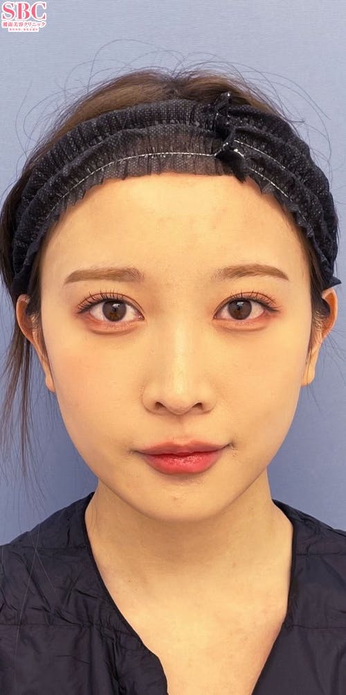 【女性・輪郭】Aquicell（アキーセル）脂肪吸引、根こそぎVASER脂肪吸引、ジョールファット除去術_before