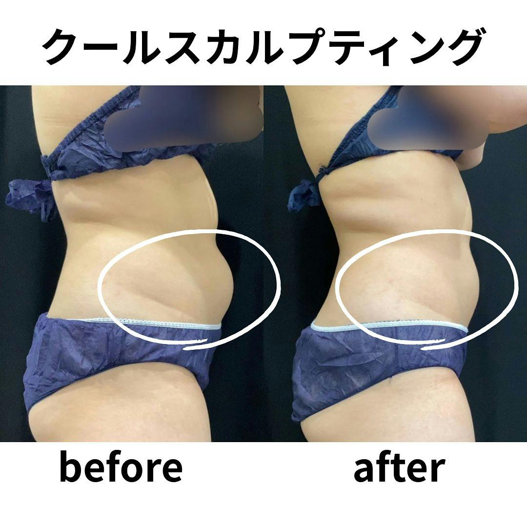 【女性・下腹部】クールスカルプティング_before_aftar
