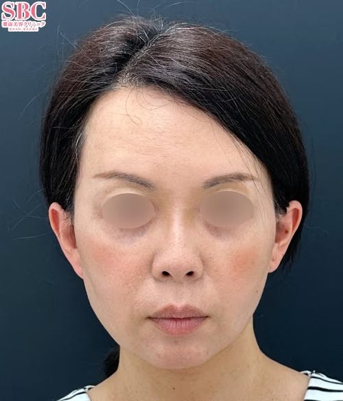 【40代女性・顔】小顔用脂肪吸引注射・バッカルファット除去・糸リフト_after